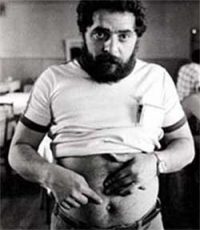 Lula na época da cirurgia do apêndice (1988). 